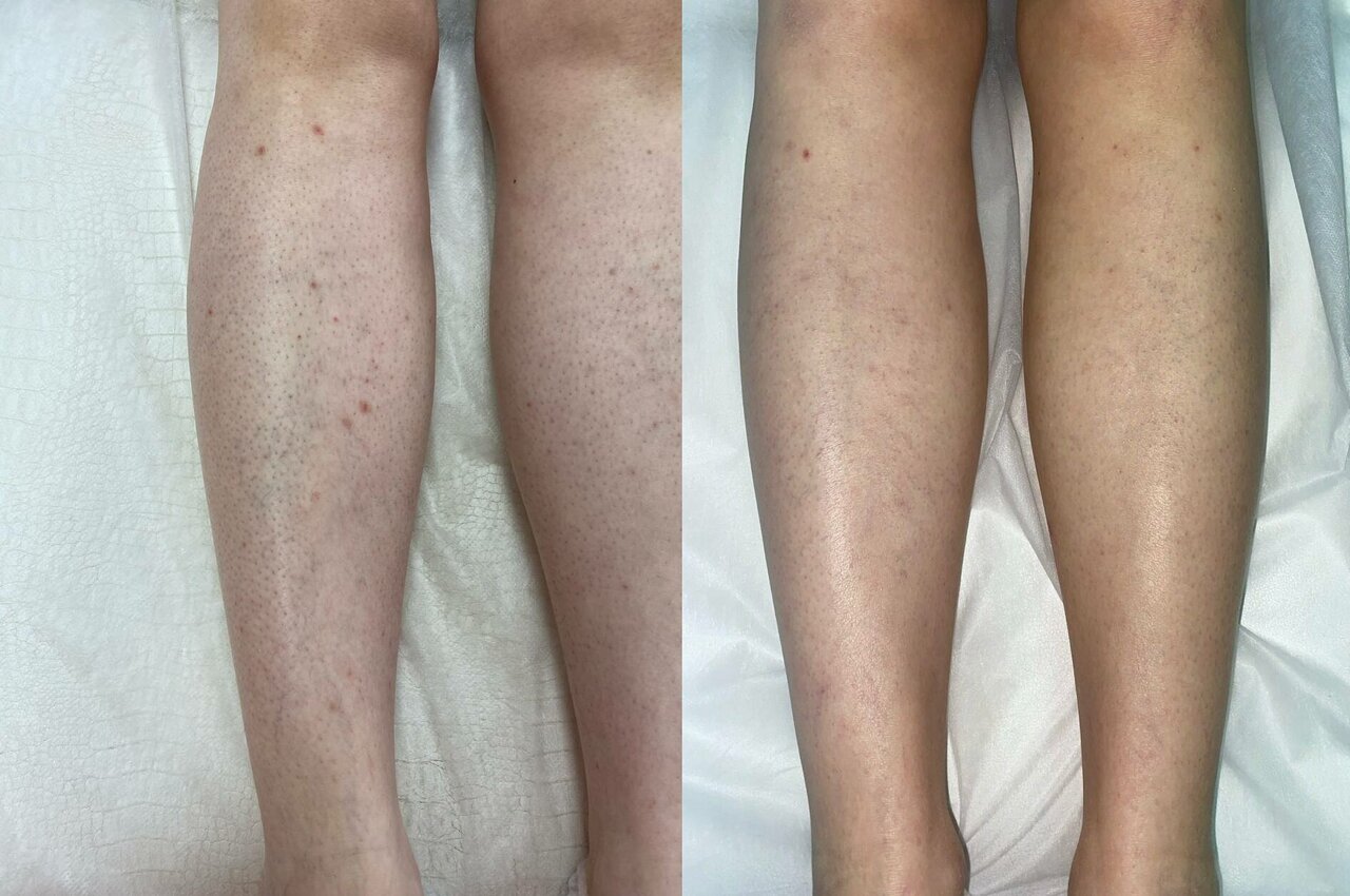 Лазер. про